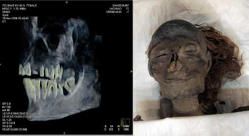 A momia de Hatshepsut e a súa radiografía (foto das web de Z.Hawass e da Cadena Ser)